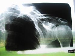 x-ray-shoulder-2008